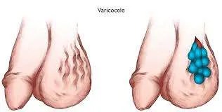 Varicocele and Varicose