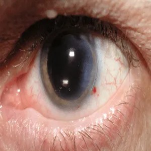 eye cataract
