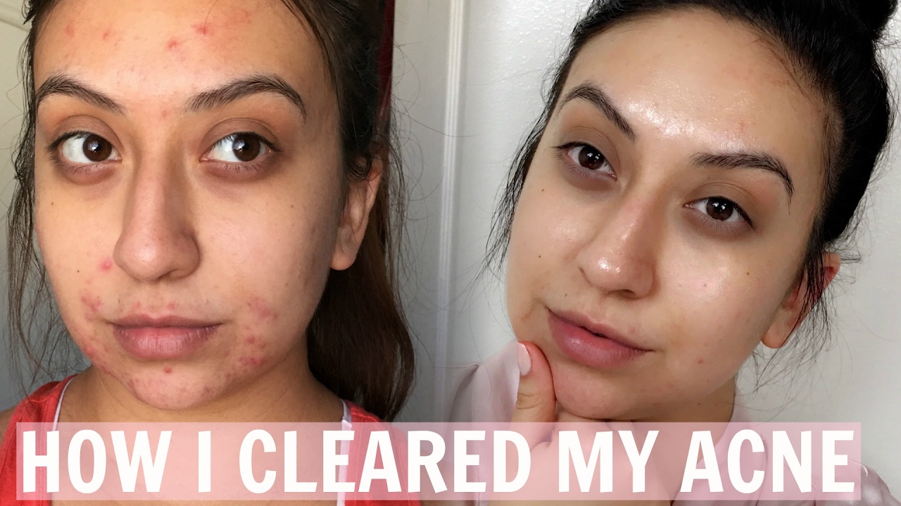 How I Cleared My Acne| Skin Care Routine 2017 - YouTube
