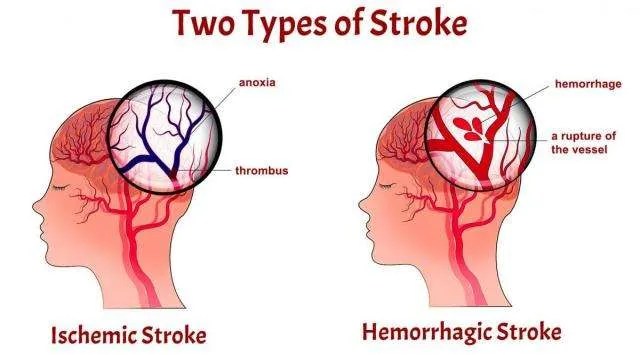 stroke care