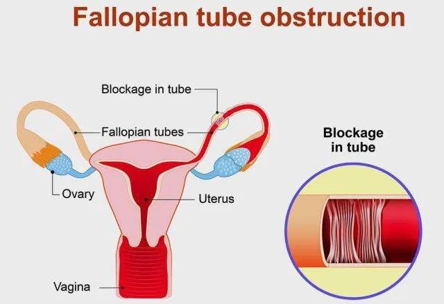 Fallopian Tubes Blockage Remedy Pack